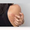 Can Laser Hair Removal Cause Skin Irritation?
