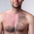 How to Reduce the Risk of Blisters After Laser Hair Removal
