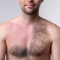The Risks and Side Effects of Laser Hair Removal