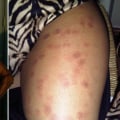 Can Laser Hair Removal Cause Long-Term Damage?