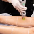 Is Brazilian Laser Hair Removal Safe and Effective? - An Expert's Perspective