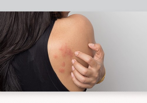 Can Laser Hair Removal Cause Skin Irritation?
