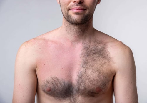 How to Reduce the Risk of Blisters After Laser Hair Removal
