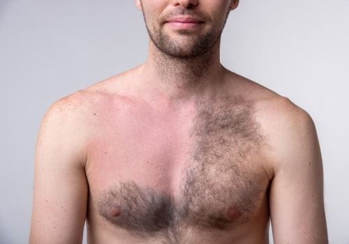 The Benefits and Risks of Laser Hair Removal