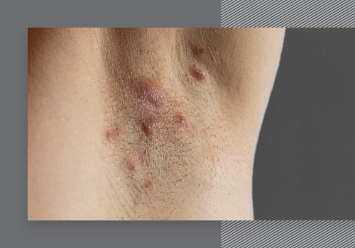 Can Laser Hair Removal Cause Infections? - An Expert's Perspective