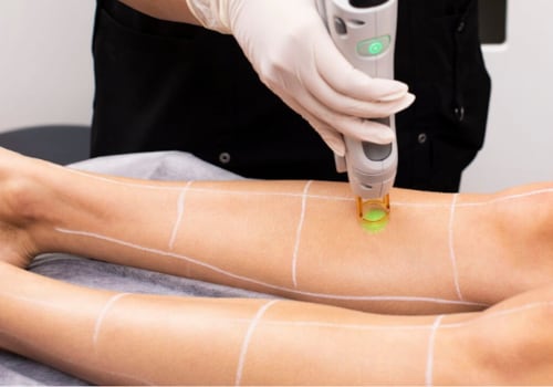 Is Brazilian Laser Hair Removal Safe and Effective? - An Expert's Perspective